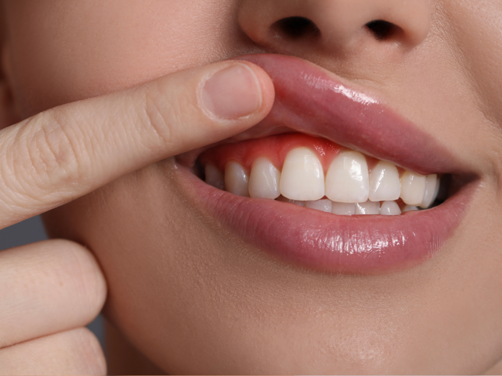 causas sangrado de encías